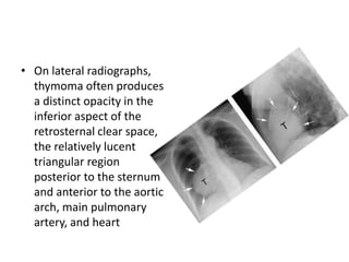 • On lateral radiographs,
thymoma often produces
a distinct opacity in the
inferior aspect of the
retrosternal clear space,
the relatively lucent
triangular region
posterior to the sternum
and anterior to the aortic
arch, main pulmonary
artery, and heart
 