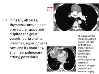 CT
• In nearly all cases,
thymomas occur in the
prevascular space and
displace the great
vessels (aorta and its
branches, superior vena
cava and its branches,
and main pulmonary
artery) posteriorly
CT shows a cystic
(fluid attenuation)
mass in the right
cardiophrenic
angle. The mass
shows dense
calcification,
including
calcification of its
capsule. A
noninvasive cystic
thymoma was
found at surgery.
 