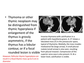 • Thymoma or other
thymic neoplasm may
be distinguished from
thymic hyperplasia if
enlargement of the
thymus is grossly
asymmetric, if the
thymus has a lobular
contour, or if a focal
rounded lesion is visible
Invasive thymoma with calcification in a
patient with myasthenia gravis. A. CT shows a
lobulated mass (T) in the prevascular space,
typical of thymoma. Medially, the mass invades
mediastinal fat (large arrow). A small pleural
nodule (small arrow) is also seen, resulting
from pleural invasion. Compression of the
superior vena cava is also present. B. At a
lower level, calcification is visible.However, follicular thymic hyperplasia can
result in a focal thymic mass up to 5 cm in
diameter
 
