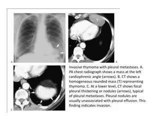 Invasive thymoma with pleural metastases. A.
PA chest radiograph shows a mass at the left
cardiophrenic angle (arrows). B. CT shows a
homogeneous rounded mass (T) representing
thymoma. C. At a lower level, CT shows focal
pleural thickening or nodules (arrows), typical
of pleural metastases. Pleural nodules are
usually unassociated with pleural effusion. This
finding indicates invasion.
 