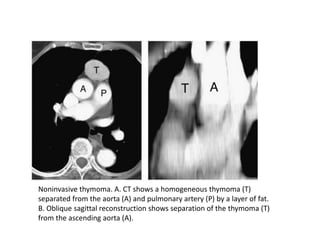 Noninvasive thymoma. A. CT shows a homogeneous thymoma (T)
separated from the aorta (A) and pulmonary artery (P) by a layer of fat.
B. Oblique sagittal reconstruction shows separation of the thymoma (T)
from the ascending aorta (A).
 