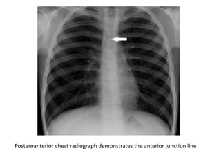 Posteroanterior chest radiograph demonstrates the anterior junction line
 