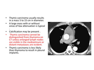 • Thymic carcinoma usually results
in a mass 5 to 15 cm in diameter.
• A large mass with or without
areas of low attenuation is typical
.
• Calcification may be present .
• Thymic carcinoma cannot be
distinguished from thymoma on
CT unless enlarged lymph nodes
are visible in the mediastinum or
distant metastases are evident.
• Thymic carcinoma is less likely
than thymoma to result in pleural
implants.
 