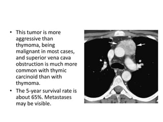 • This tumor is more
aggressive than
thymoma, being
malignant in most cases,
and superior vena cava
obstruction is much more
common with thymic
carcinoid than with
thymoma.
• The 5-year survival rate is
about 65%. Metastases
may be visible.
 