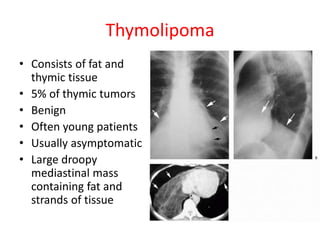 Thymolipoma
• Consists of fat and
thymic tissue
• 5% of thymic tumors
• Benign
• Often young patients
• Usually asymptomatic
• Large droopy
mediastinal mass
containing fat and
strands of tissue
 
