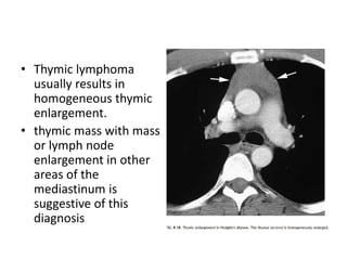 • Thymic lymphoma
usually results in
homogeneous thymic
enlargement.
• thymic mass with mass
or lymph node
enlargement in other
areas of the
mediastinum is
suggestive of this
diagnosis
 