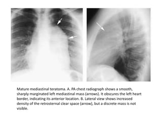 Mature mediastinal teratoma. A. PA chest radiograph shows a smooth,
sharply marginated left mediastinal mass (arrows). It obscures the left heart
border, indicating its anterior location. B. Lateral view shows increased
density of the retrosternal clear space (arrow), but a discrete mass is not
visible.
 