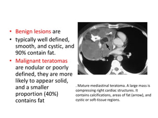 • Benign lesions are
• typically well defined,
smooth, and cystic, and
90% contain fat.
• Malignant teratomas
are nodular or poorly
defined, they are more
likely to appear solid,
and a smaller
proportion (40%)
contains fat
. Mature mediastinal teratoma. A large mass is
compressing right cardiac structures. It
contains calcifications, areas of fat (arrow), and
cystic or soft-tissue regions.
 