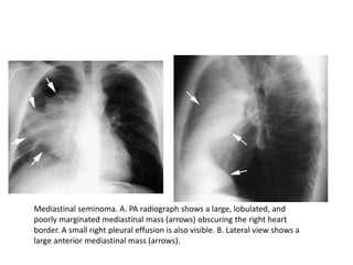 Mediastinal seminoma. A. PA radiograph shows a large, lobulated, and
poorly marginated mediastinal mass (arrows) obscuring the right heart
border. A small right pleural effusion is also visible. B. Lateral view shows a
large anterior mediastinal mass (arrows).
 