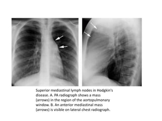Superior mediastinal lymph nodes in Hodgkin's
disease. A. PA radiograph shows a mass
(arrows) in the region of the aortopulmonary
window. B. An anterior mediastinal mass
(arrows) is visible on lateral chest radiograph.
 