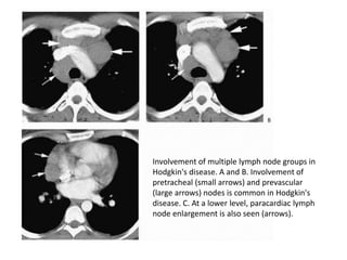 Involvement of multiple lymph node groups in
Hodgkin's disease. A and B. Involvement of
pretracheal (small arrows) and prevascular
(large arrows) nodes is common in Hodgkin's
disease. C. At a lower level, paracardiac lymph
node enlargement is also seen (arrows).
 