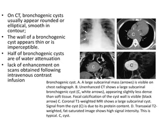 • On CT, bronchogenic cysts
usually appear rounded or
elliptical, smooth in
contour;
• The wall of a bronchogenic
cyst appears thin or is
imperceptible.
• Half of bronchogenic cysts
are of water attenuation
• lack of enhancement on
scans obtained following
intravenous contrast
infusion Bronchogenic cyst. A. A large subcarinal mass (arrows) is visible on
chest radiograph. B. Unenhanced CT shows a large subcarinal
bronchogenic cyst (C, white arrows), appearing slightly less dense
than soft tissue. Focal calcification of the cyst wall is visible (black
arrow) C. Coronal T1-weighted MRI shows a large subcarinal cyst.
Signal from the cyst (C) is due to its protein content. D. Transaxial T2-
weighted, fat-saturated image shows high signal intensity. This is
typical. C, cyst.
 