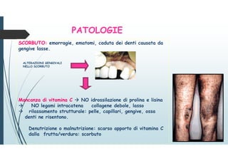 PATOLOGIE
SCORBUTO: emorragie, ematomi, caduta dei denti causata da
gengive lasse.
Mancanza di vitamina C  NO idrossilazione di prolina e lisina
 NO legami intracatena collagene debole, lasso
 rilassamento strutturale: pelle, capillari, gengive, ossa
denti ne risentono.
Denutrizione o malnutrizione: scarso apporto di vitamina C
dalla frutta/verdura: scorbuto
ALTERAZIONI GENGIVALI
NELLO SCORBUTO
 