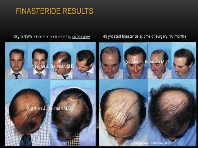 finasteride 5 months no results