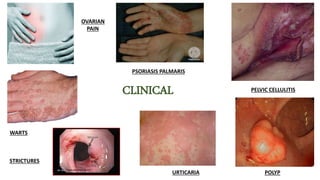 CLINICAL
OVARIAN
PAIN
PSORIASIS PALMARIS
WARTS
STRICTURES
URTICARIA
PELVIC CELLULITIS
POLYP
 