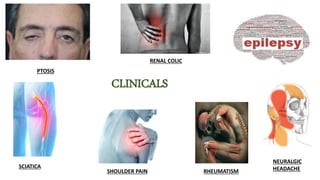 CLINICALS
PTOSIS
SCIATICA
SHOULDER PAIN RHEUMATISM
NEURALGIC
HEADACHE
RENAL COLIC
 
