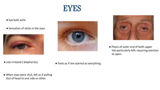 EYES
● Feels as if she starred at everything.
● Eye balls ache
● Sensation of sticks in the eyes
● Lids irritated { blepharitis}
● When eyes were shut, felt as if pulling
Out of head to one side or other.
● Ptosis of outer end of both upper
lids particularly left; requiring exertion
to open.
 
