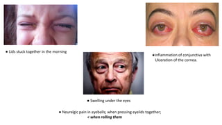 ● Lids stuck together in the morning
●Inflammation of conjunctiva with
Ulceration of the cornea.
● Neuralgic pain in eyeballs; when pressing eyelids together;
< when rolling them
● Swelling under the eyes
 