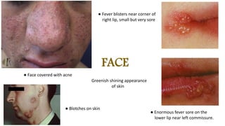 FACE
● Blotches on skin
● Face covered with acne
● Fever blisters near corner of
right lip, small but very sore
● Enormous fever sore on the
lower lip near left commissure.
Greenish shining appearance
of skin
 