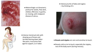 ● Metrorrhagia: at climacteric;
profuse for weeks, flow dark,
clotted, offensive; in gushes,
on moving; with malignant
disease of uterus.
● Intense menstrual colic with
drawing up of knees and
terrible bearing down labor-
like pains; must press feet
against support, as in labor.
● Intense pruritis of labia and vagina
< by thinking of it.
● Breasts and nipples are sore and sensitive to touch.
● Breasts cold as ice to touch, especially the nipples,
rest of the body warm (during menses).
 