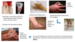 ● Drawing, constricting sensation in
hamstrings and ankles; cramps in
calves and soles.( cupr.).
● Ankles turn easily when walking.
● Deformity of finger joints;
Large
puffy
knuckles;
Great
tenderness
of heels &
balls of feet;
Swelling of all joints, were puffy,
like windgalls.
Swelling &
Painful
Stiffness of
Ankles.
It cures the tenderness in the soles so common in chronic gonorrheal
Rheumatism. Tenderness of soles so that he had to walk on his knees.
[KENT]
 