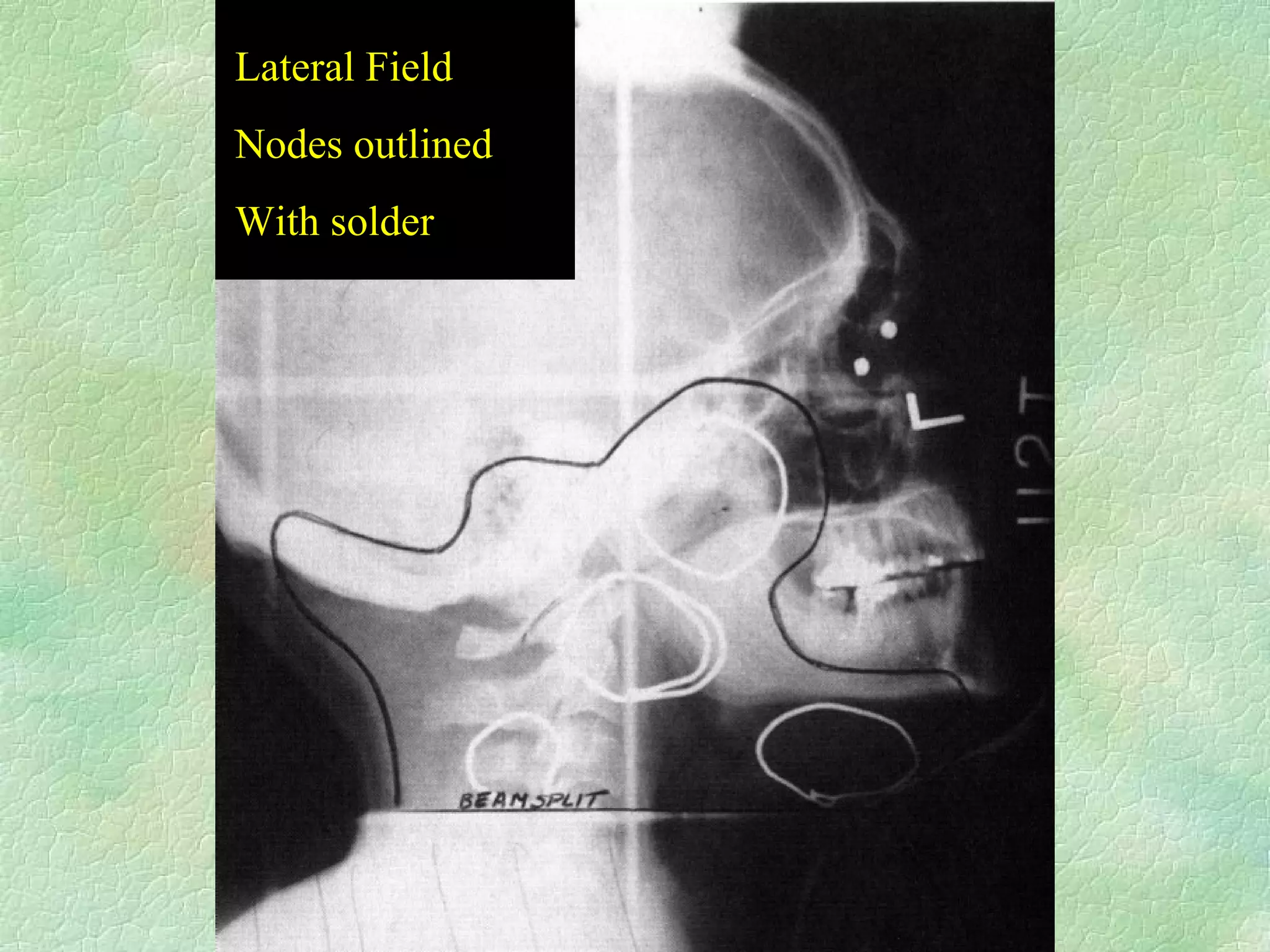Lateral Field Nodes outlined With solder 