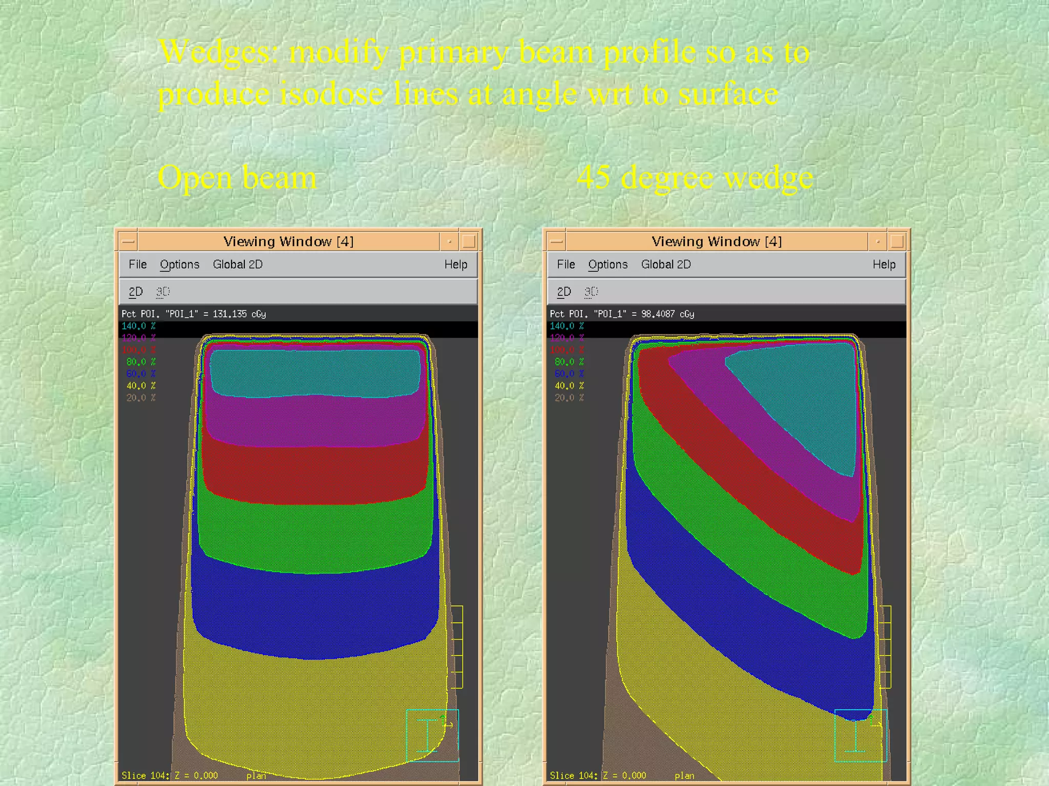 Wedges: modify primary beam profile so as to  produce isodose lines at angle wrt to surface Open beam  45 degree wedge  
