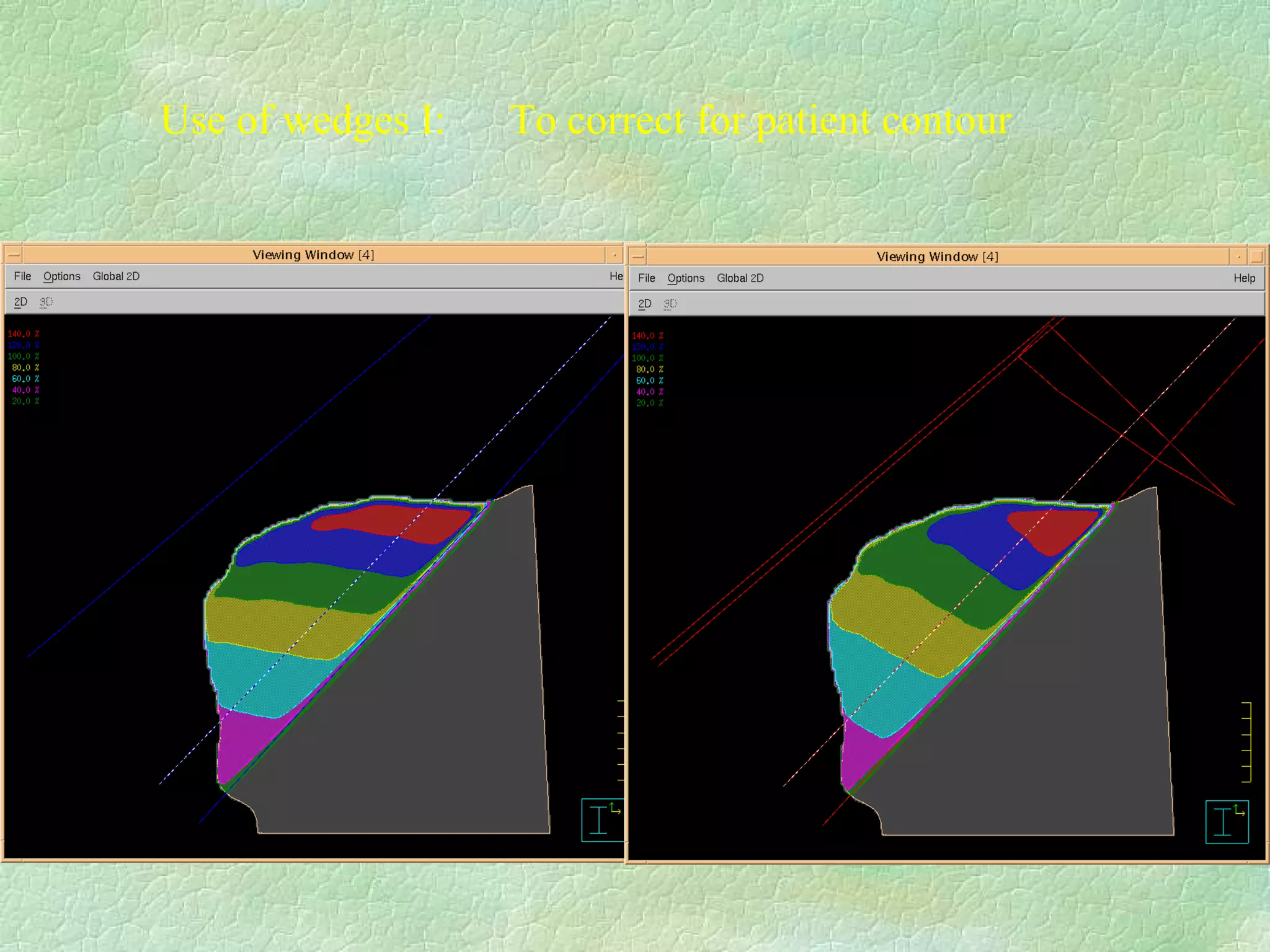 Use of wedges I:  To correct for patient contour  