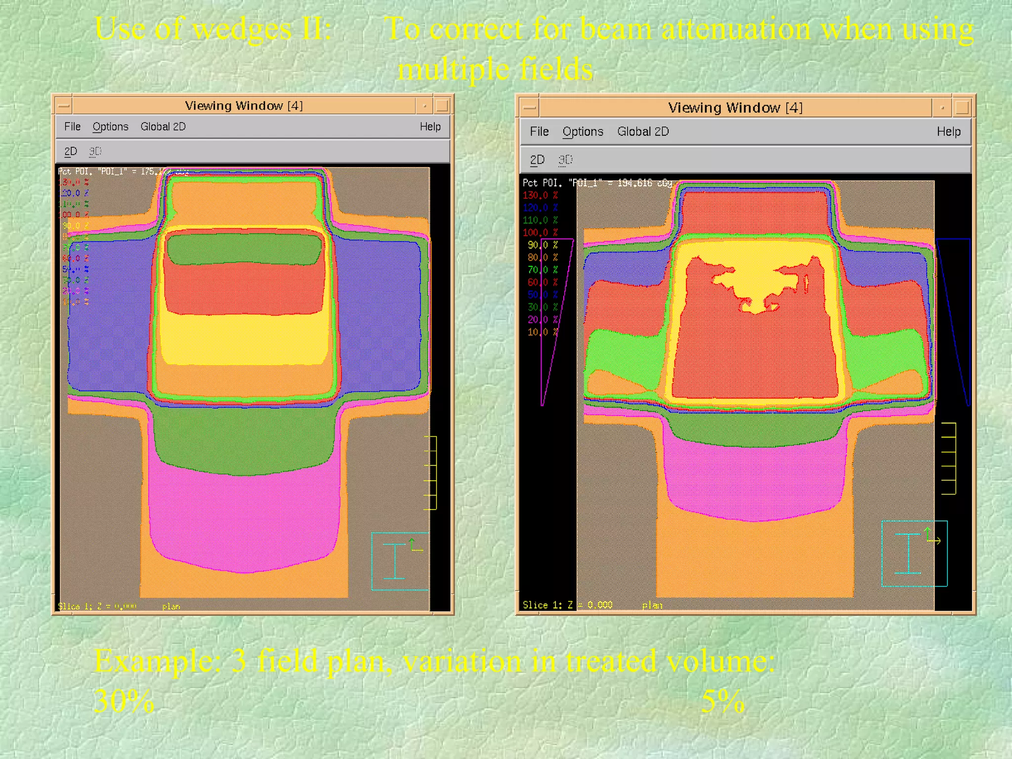 Use of wedges II:  To correct for beam attenuation when using multiple fields  Example: 3 field plan, variation in treated volume: 30% 5%  