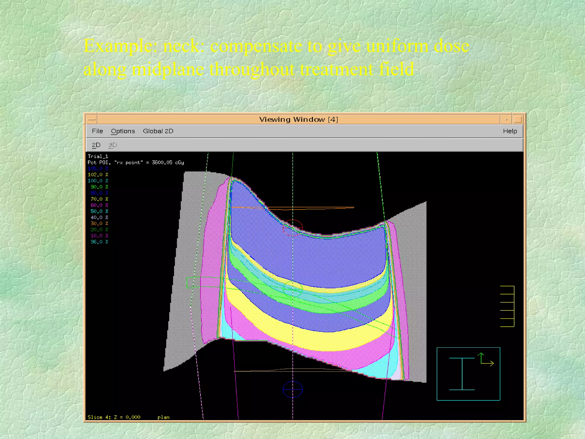 Example: neck: compensate to give uniform dose along midplane throughout treatment field  