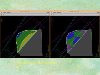 Variation at level of isocentre: 40% 5%  