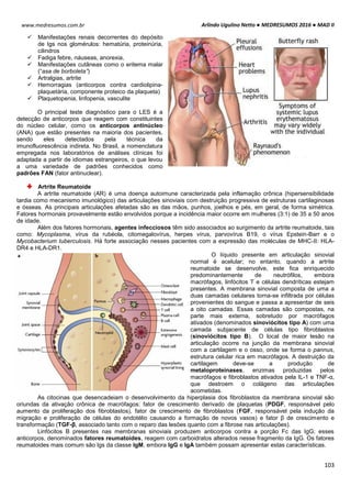 Arlindo Ugulino Netto ● MEDRESUMOS 2016 ● MAD II
103
www.medresumos.com.br
 Manifestações renais decorrentes do depósito
de Igs nos glomérulos: hematúria, proteinúria,
cilindros
 Fadiga febre, náuseas, anorexia,
 Manifestações cutâneas como o eritema malar
(“asa de borboleta”)
 Artralgias, artrite
 Hemorragias (anticorpos contra cardiolipina-
plaquetária, componente proteico da plaqueta)
 Plaquetopenia, linfopenia, vasculite
O principal teste diagnóstico para o LES é a
detecção de anticorpos que reagem com constituintes
do núcleo celular, como os anticorpos antinúcleo
(ANA) que estão presentes na maioria dos pacientes,
sendo eles detectados pela técnica da
imunofluorescência indireta. No Brasil, a nomenclatura
empregada nos laboratórios de análises clínicas foi
adaptada a partir de idiomas estrangeiros, o que levou
a uma variedade de padrões conhecidos como
padrões FAN (fator antinuclear).
Artrite Reumatoide
A artrite reumatoide (AR) é uma doença autoimune caracterizada pela inflamação crônica (hipersensibilidade
tardia como mecanismo imunológico) das articulações sinoviais com destruição progressiva de estruturas cartilaginosas
e ósseas. As principais articulações afetadas são as das mãos, punhos, joelhos e pés, em geral, de forma simétrica.
Fatores hormonais provavelmente estão envolvidos porque a incidência maior ocorre em mulheres (3:1) de 35 a 50 anos
de idade.
Além dos fatores hormonais, agentes infecciosos têm sido associados ao surgimento da artrite reumatoide, tais
como: Mycoplasma, vírus da rubéola, citomegalovírus, herpes vírus, parvovírus B19, o vírus Epstein-Barr e o
Mycobacterium tuberculosis. Há forte associação nesses pacientes com a expressão das moléculas de MHC-II: HLA-
DR4 e HLA-DR1.
O líquido presente em articulação sinovial
normal é acelular; no entanto, quando a artrite
reumatoide se desenvolve, este fica enriquecido
predominantemente de neutrófilos, embora
macrófagos, linfócitos T e células dendríticas estejam
presentes. A membrana sinovial composta de uma a
duas camadas celulares torna-se infiltrada por células
provenientes do sangue e passa a apresentar de seis
a oito camadas. Essas camadas são compostas, na
parte mais externa, sobretudo por macrófagos
ativados (denominados sinoviócitos tipo A) com uma
camada subjacente de células tipo fibroblastos
(sinoviócitos tipo B). O local de maior lesão na
articulação ocorre na junção da membrana sinovial
com a cartilagem e o osso, onde se forma o pannus,
estrutura celular rica em macrófagos. A destruição da
cartilagem deve-se a produção de
metaloproteinases, enzimas produzidas pelos
macrófagos e fibroblastos ativados pela IL-1 e TNF-α,
que destroem o colágeno das articulações
acometidas.
As citocinas que desencadeiam o desenvolvimento da hiperplasia dos fibroblastos da membrana sinovial são
oriundas da ativação crônica de macrófagos: fator de crescimento derivado de plaquetas (PDGF, responsável pelo
aumento da proliferação dos fibroblastos), fator de crescimento de fibroblastos (FGF, responsável pela indução da
migração e proliferação de células do endotélio causando a formação de novos vasos) e fator β de crescimento e
transformação (TGF-β, associado tanto com o reparo das lesões quanto com a fibrose nas articulações).
Linfócitos B presentes nas membranas sinoviais produzem anticorpos contra a porção Fc das IgG; esses
anticorpos, denominados fatores reumatoides, reagem com carboidratos alterados nesse fragmento da IgG. Os fatores
reumatoides mais comum são Igs da classe IgM, embora IgG e IgA também possam apresentar estas características.
 