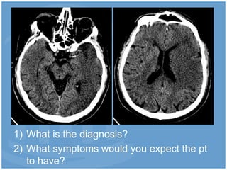 1) What is the diagnosis?
2) What symptoms would you expect the pt
   to have?
 