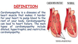 DEFINITION
Cardiomyopathy is a diseases of the
heart muscle that makes it harder
for your heart to pump blood to the
rest of your body. Cardiomyopathy
can lead to heart failure. The main
types of cardiomyopathy include
dilated, hypertrophic and restrictive
cardiomyopathy.
 