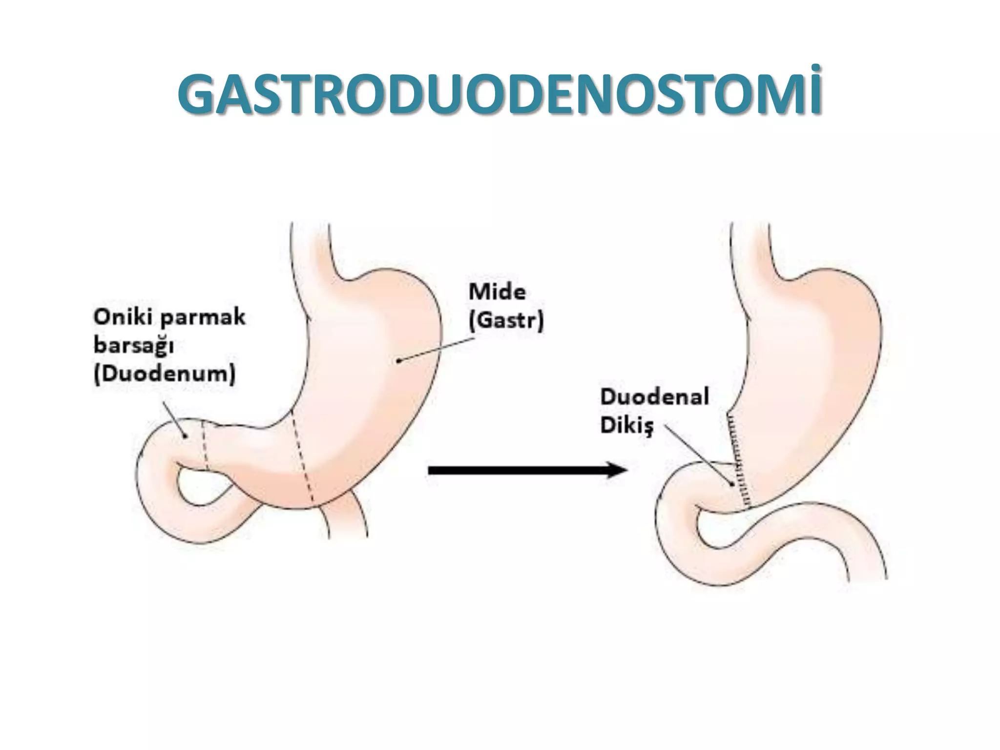GASTRODUODENOSTOMİ
 