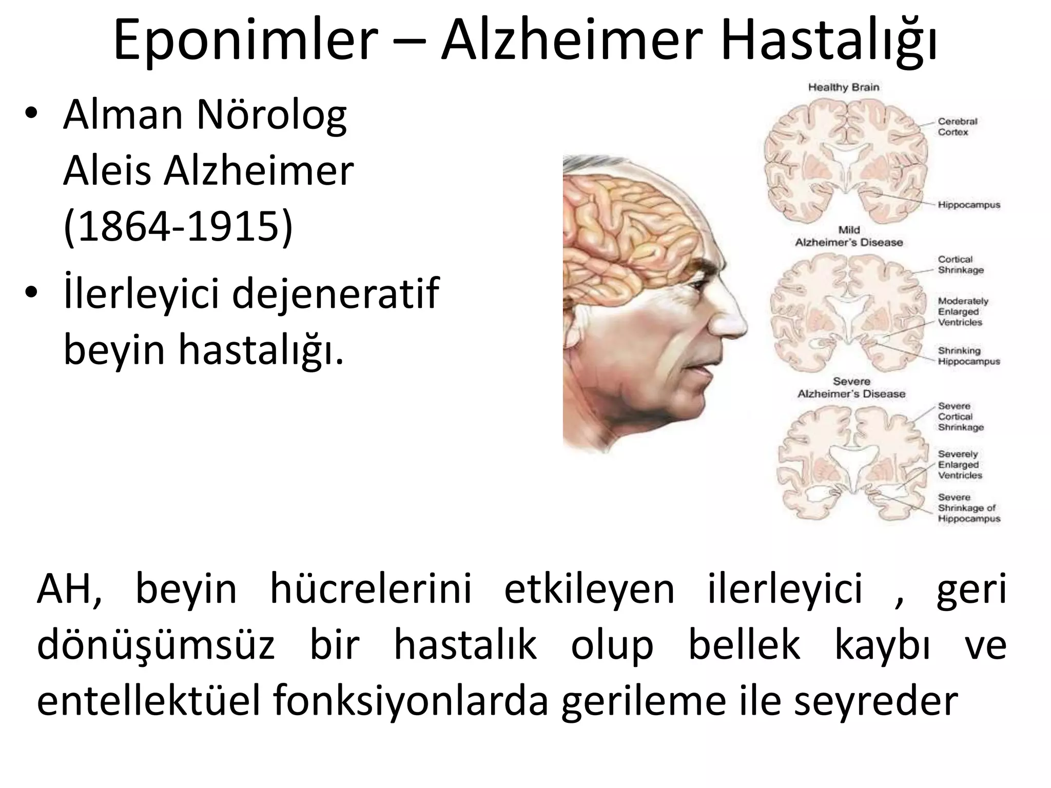 Eponimler – Alzheimer Hastalığı
• Alman Nörolog
Aleis Alzheimer
(1864-1915)
• İlerleyici dejeneratif
beyin hastalığı.
AH, beyin hücrelerini etkileyen ilerleyici , geri
dönüşümsüz bir hastalık olup bellek kaybı ve
entellektüel fonksiyonlarda gerileme ile seyreder
 