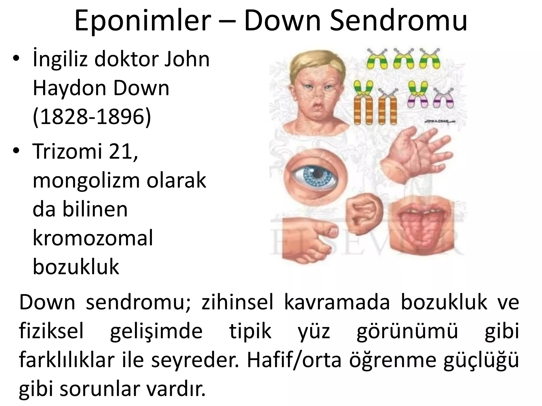 Eponimler – Down Sendromu
• İngiliz doktor John
Haydon Down
(1828-1896)
• Trizomi 21,
mongolizm olarak
da bilinen
kromozomal
bozukluk
Down sendromu; zihinsel kavramada bozukluk ve
fiziksel gelişimde tipik yüz görünümü gibi
farklılıklar ile seyreder. Hafif/orta öğrenme güçlüğü
gibi sorunlar vardır.
 