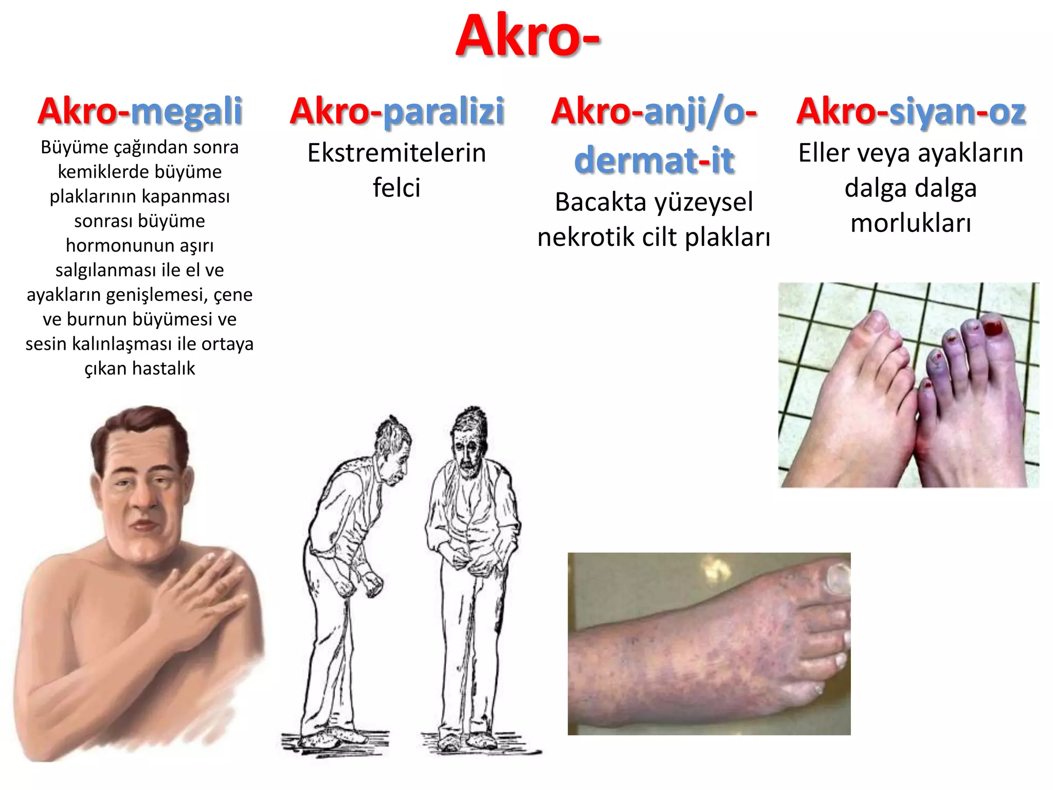 Akro-
Akro-megali
Büyüme çağından sonra
kemiklerde büyüme
plaklarının kapanması
sonrası büyüme
hormonunun aşırı
salgılanması ile el ve
ayakların genişlemesi, çene
ve burnun büyümesi ve
sesin kalınlaşması ile ortaya
çıkan hastalık
Akro-paralizi
Ekstremitelerin
felci
Akro-anji/o-
dermat-it
Bacakta yüzeysel
nekrotik cilt plakları
Akro-siyan-oz
Eller veya ayakların
dalga dalga
morlukları
 