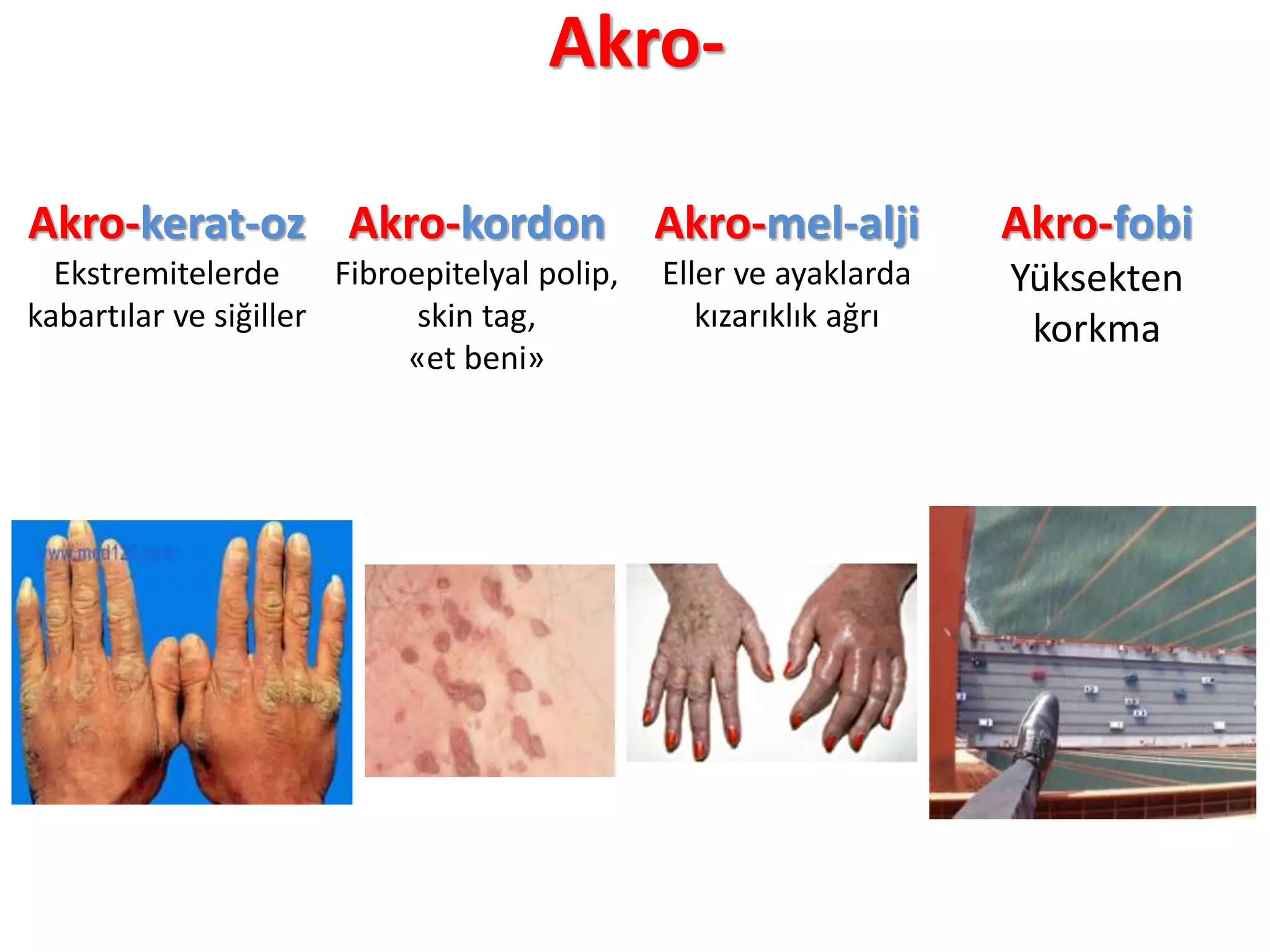 Akro-
Akro-kerat-oz
Ekstremitelerde
kabartılar ve siğiller
Akro-kordon
Fibroepitelyal polip,
skin tag,
«et beni»
Akro-mel-alji
Eller ve ayaklarda
kızarıklık ağrı
Akro-fobi
Yüksekten
korkma
 