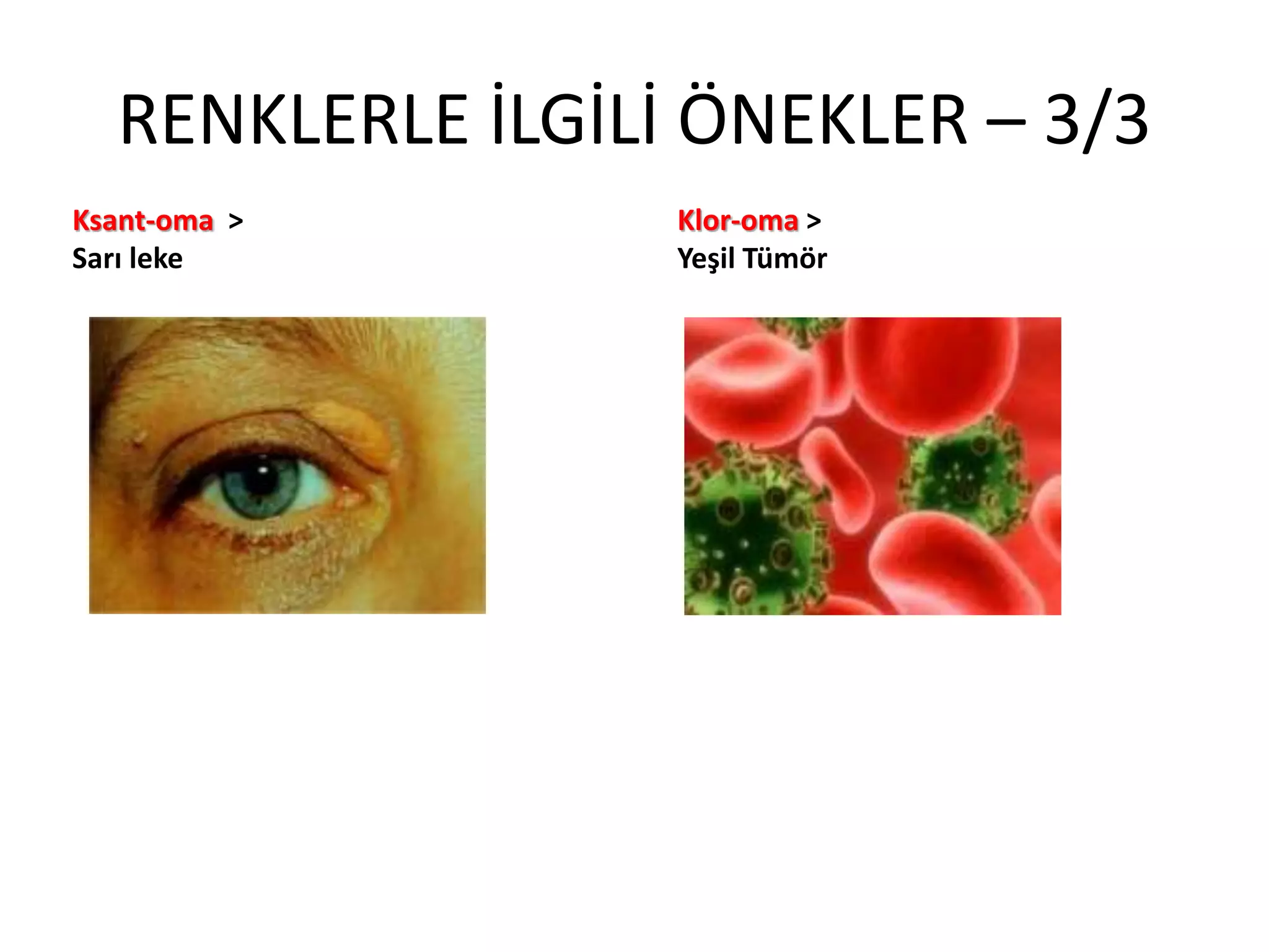 RENKLERLE İLGİLİ ÖNEKLER – 3/3
Ksant-oma >
Sarı leke
Klor-oma >
Yeşil Tümör
 