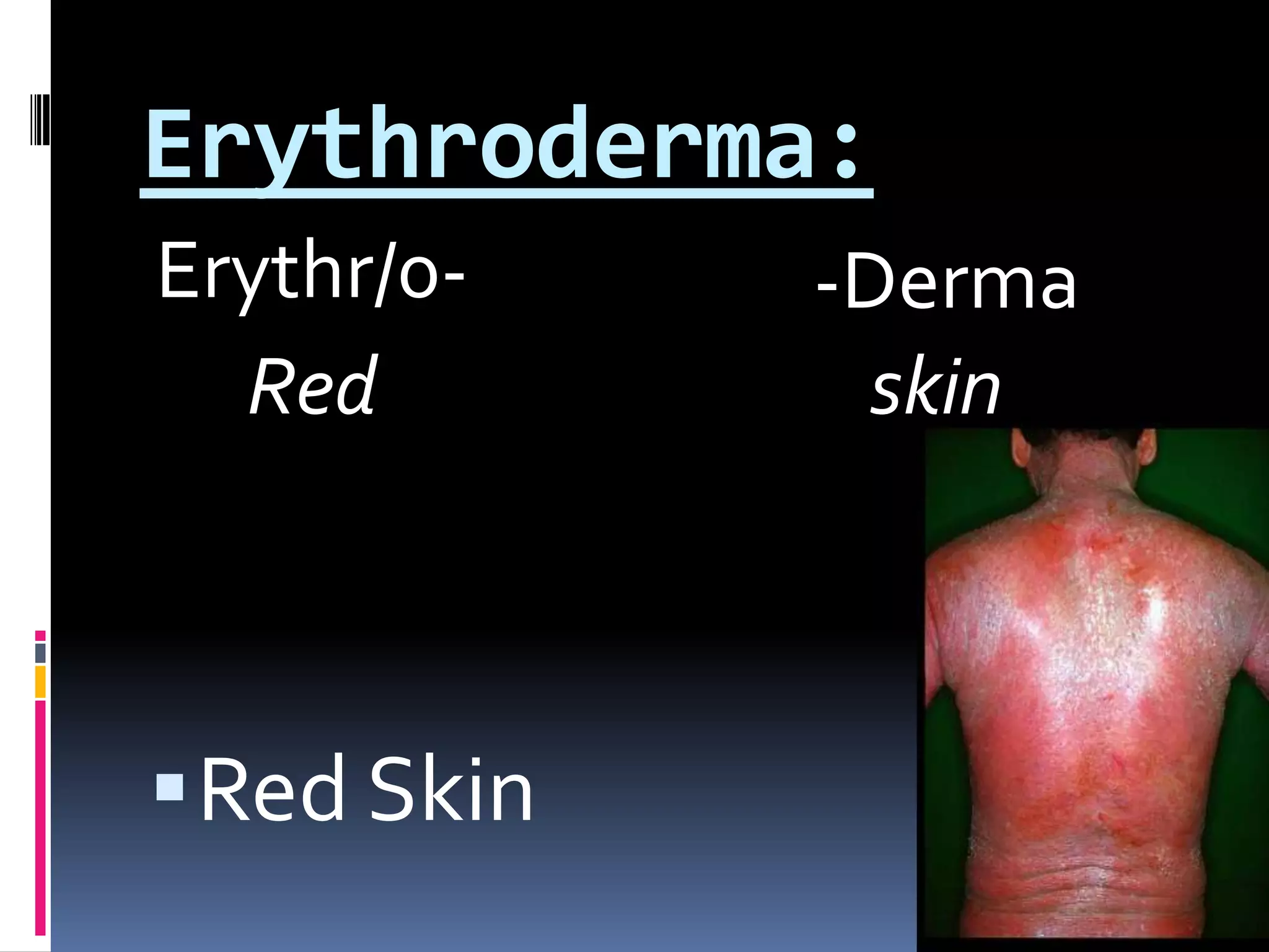 Erythroderma:Erythr/0--DermaRed SkinRedskin