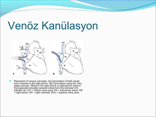 Venöz Kanülasyon
 Placement of venous cannulas. (A) Cannulation of both cavae
from incisions in the right atrium. (B) Cannulation using the "two-
stage cannula." Blood in the right atrium is captured by vents in
the expanded shoulder several inches from the narrower IVC
catheter tip. IVC = inferior vena cava; PA = pulmonary artery; RA
= right atrium; RV = right ventricle; SVC = superior vena cava.
 