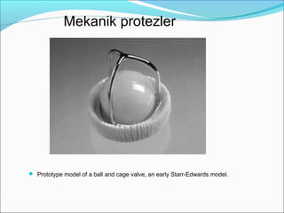  Prototype model of a ball and cage valve, an early Starr-Edwards model.
Mekanik protezler
 