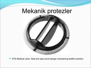 Mekanik protezler
 ATS Medical valve. Note the open pivot design maintaining leaflet insertion.
 