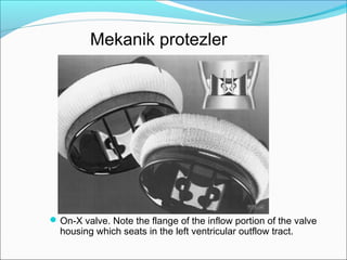 On-X valve. Note the flange of the inflow portion of the valve
housing which seats in the left ventricular outflow tract.
Mekanik protezler
 