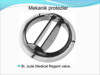 St. Jude Medical Regent valve.
Mekanik protezler
 