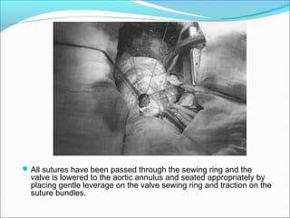 All sutures have been passed through the sewing ring and the
valve is lowered to the aortic annulus and seated appropriately by
placing gentle leverage on the valve sewing ring and traction on the
suture bundles.
 