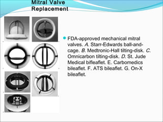 FDA-approved mechanical mitral
valves. A. Starr-Edwards ball-and-
cage. B. Medtronic-Hall tilting-disk. C.
Omnicarbon tilting-disk. D. St. Jude
Medical bifleaflet. E. Carbomedics
bileaflet. F. ATS bileaflet. G. On-X
bileaflet.
Mitral Valve
Replacement
 