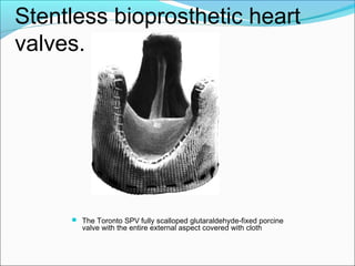 Stentless bioprosthetic heart
valves.
 The Toronto SPV fully scalloped glutaraldehyde-fixed porcine
valve with the entire external aspect covered with cloth
 