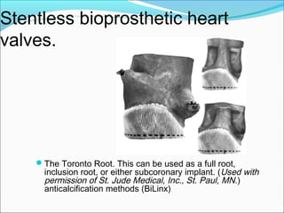 Stentless bioprosthetic heart
valves.
The Toronto Root. This can be used as a full root,
inclusion root, or either subcoronary implant. (Used with
permission of St. Jude Medical, Inc., St. Paul, MN.)
anticalcification methods (BiLinx)
 